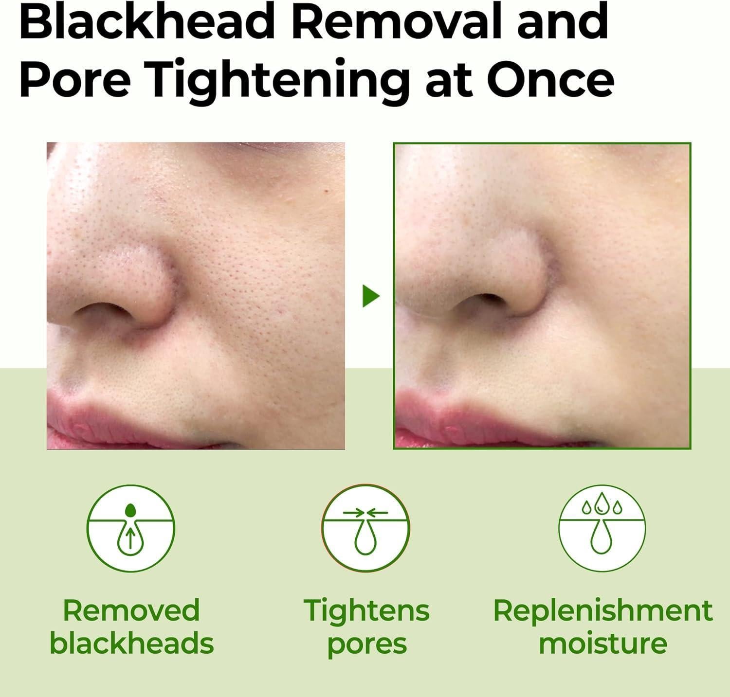 BHA toner with willow bark extract for oily and acne prone skin