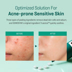 Blemish care cream for acne prone skin and clogged pores