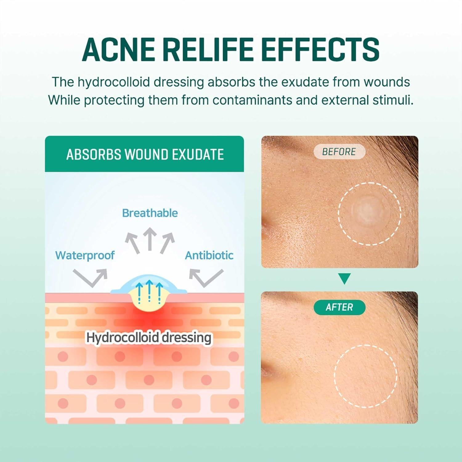 Transparent spot patch for acne prone skin